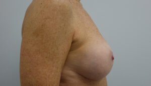 After Breast Implants