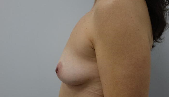Before-Breast Implants