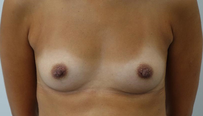 Before-Breast Implants