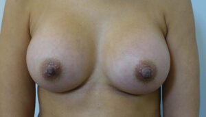 After Implants