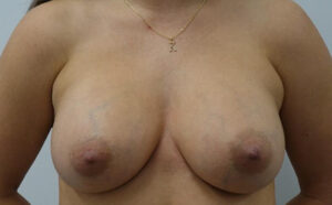 After Breast Implants