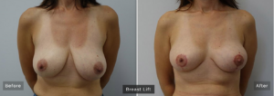 A breast lift, as seen in these before and after shots, can renew the appearance of tired-looking or low hanging breasts.