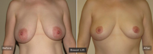 A breast lift can restore your breasts to a more youthful, alert-looking position. Here's a result from a real patient at Oakville Plastic Surgery.