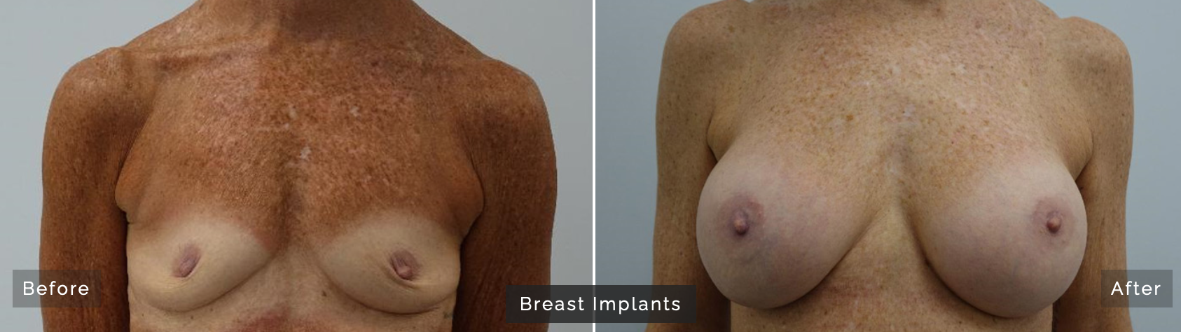 Breast augmentation with implants can elevate your breasts several cup sizes with a beautiful, natural-looking result. Here's a patient example from our Oakville clinic.