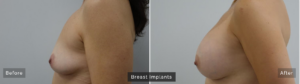 Here's an example of how breast implants can fill out the breast area and take you up a cup size with natural-looking results.