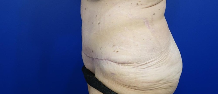 CStummyLlat5wks | Oakville Plastic Surgery – Dr. Nancy de Kleer
