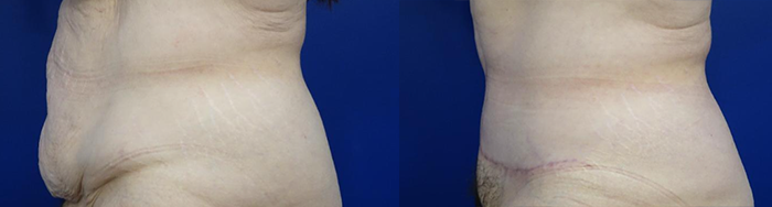Fleur de lis before and after