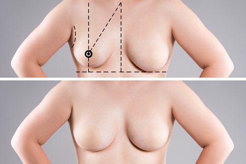 Before and after images of breast asymmetry procedure