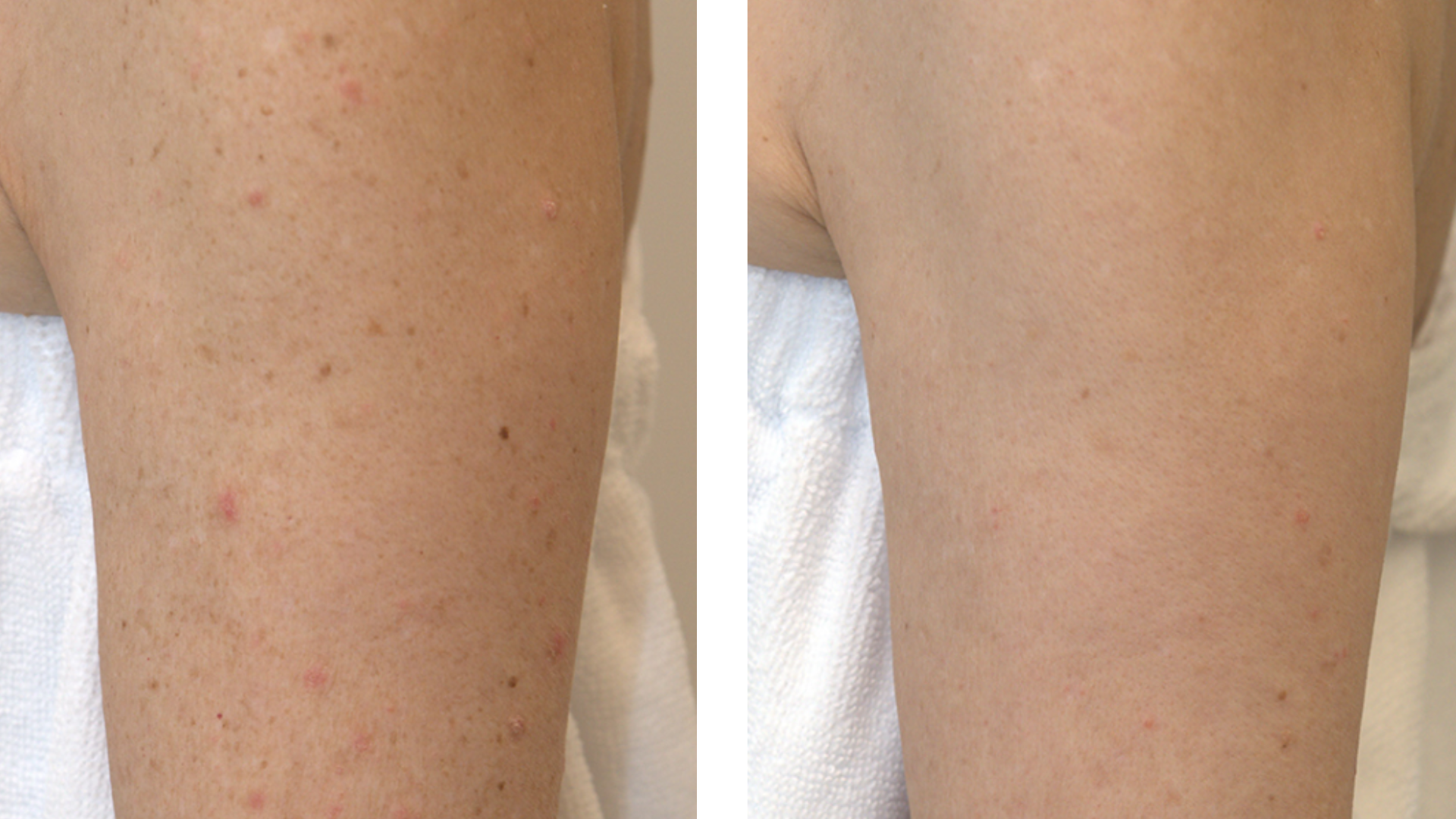 Before-and-after BBL treatment showing reduced redness and pigmentation on the upper arm.