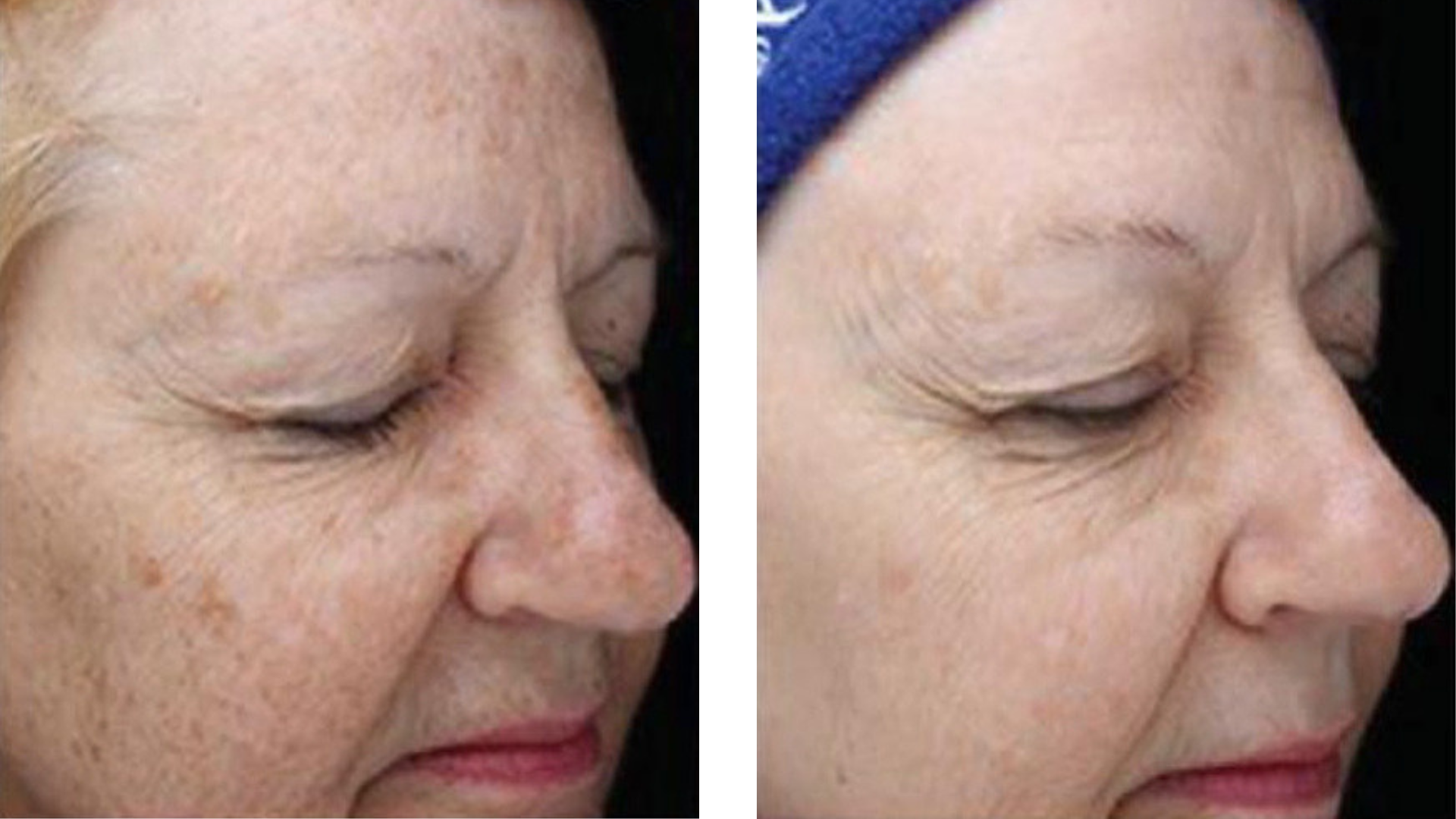 Before-and-after BBL treatment showing reduced facial pigmentation and a more even complexion.