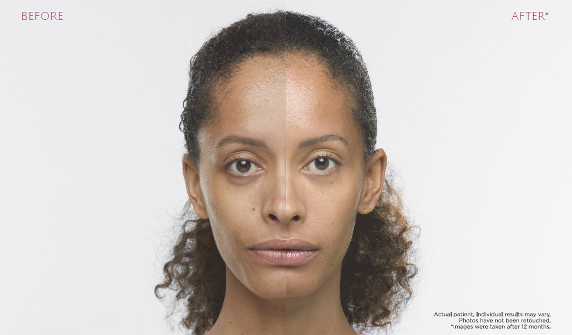Patient who received Sculptra treatment, before and after results