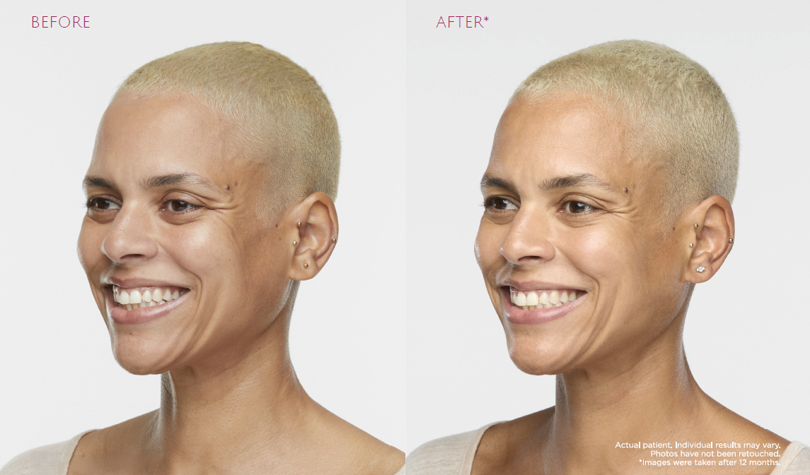 Patient who received Sculptra treatment, before and after results
