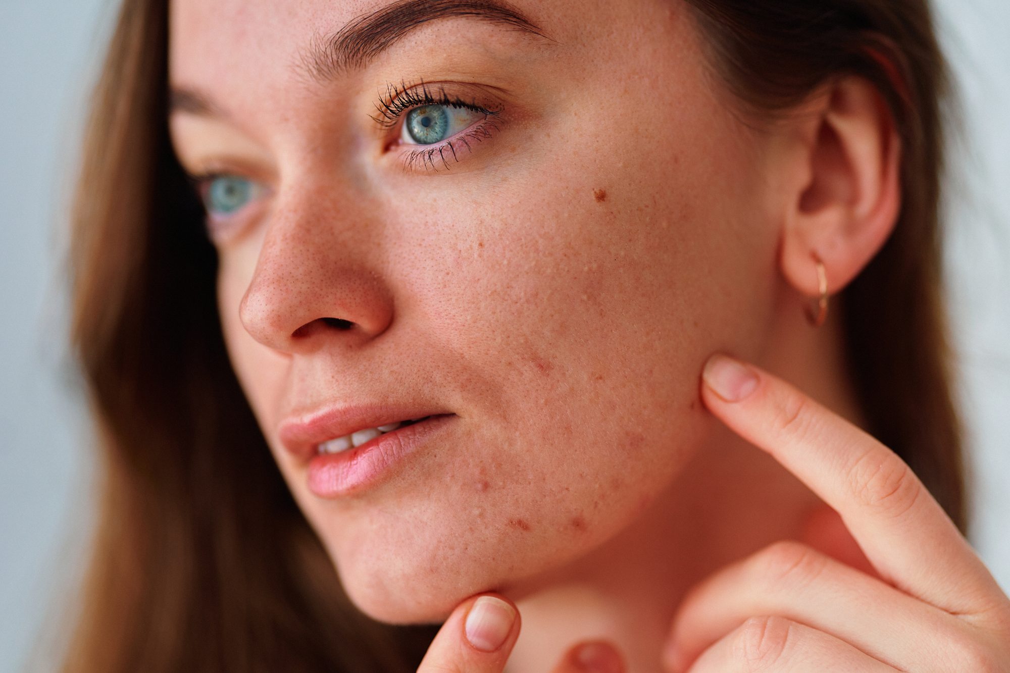 Woman pointing to blemishes and acne marks on her cheek while examining her skin.